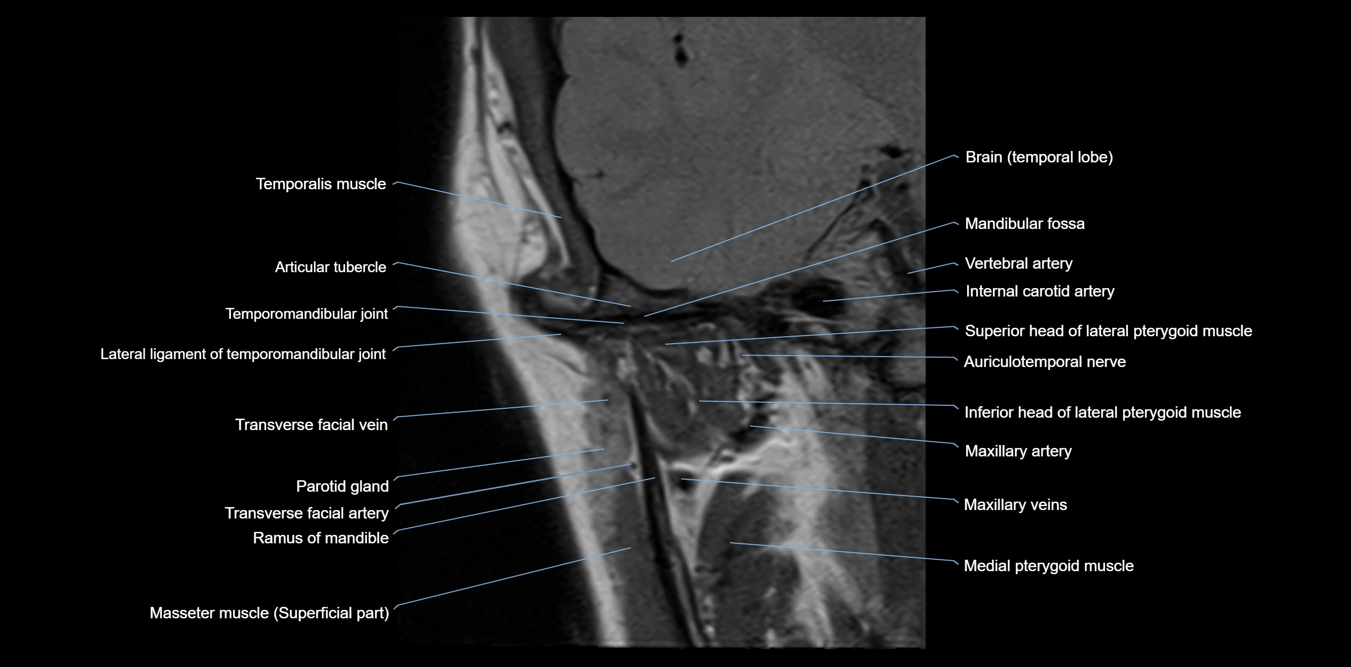 MRI TMJ coronal cross sectional 3T anatomy -img-00004-00003.webp